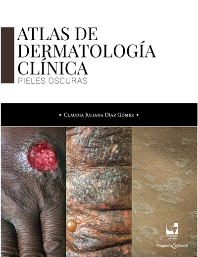 Atlas de dermatología clínica: pieles oscuras