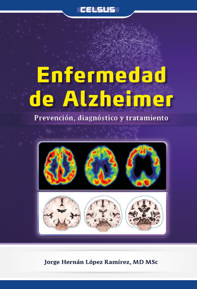 Enfermedad de Alzheimer: prevención, diagnóstico y tratamiento
