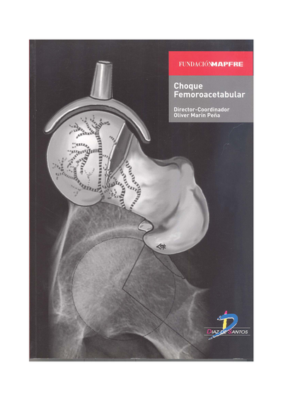 Choque femoroacetabular