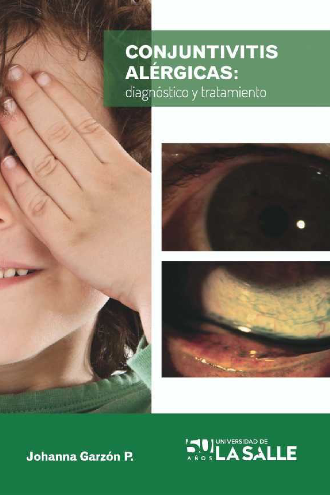 Conjuntivitis alérgicas: diagnóstico y tratamiento