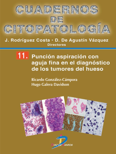 Cuadernos de citopatología 11: punción aspiración con aguja fina en el diagnóstico de los tumores del hueso